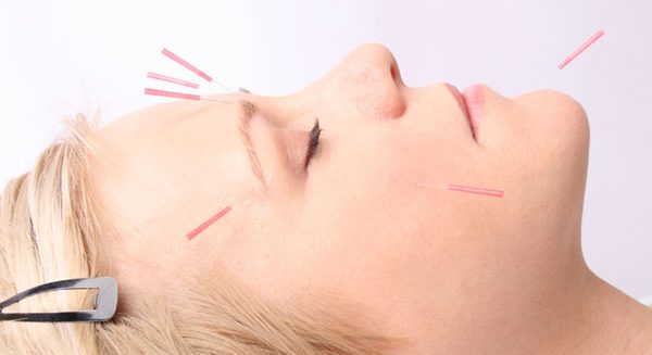 Cosmetic Acupuncture