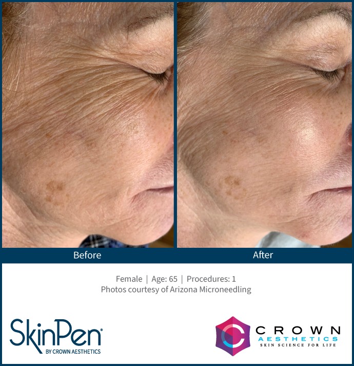 SkinPen treatment example 1