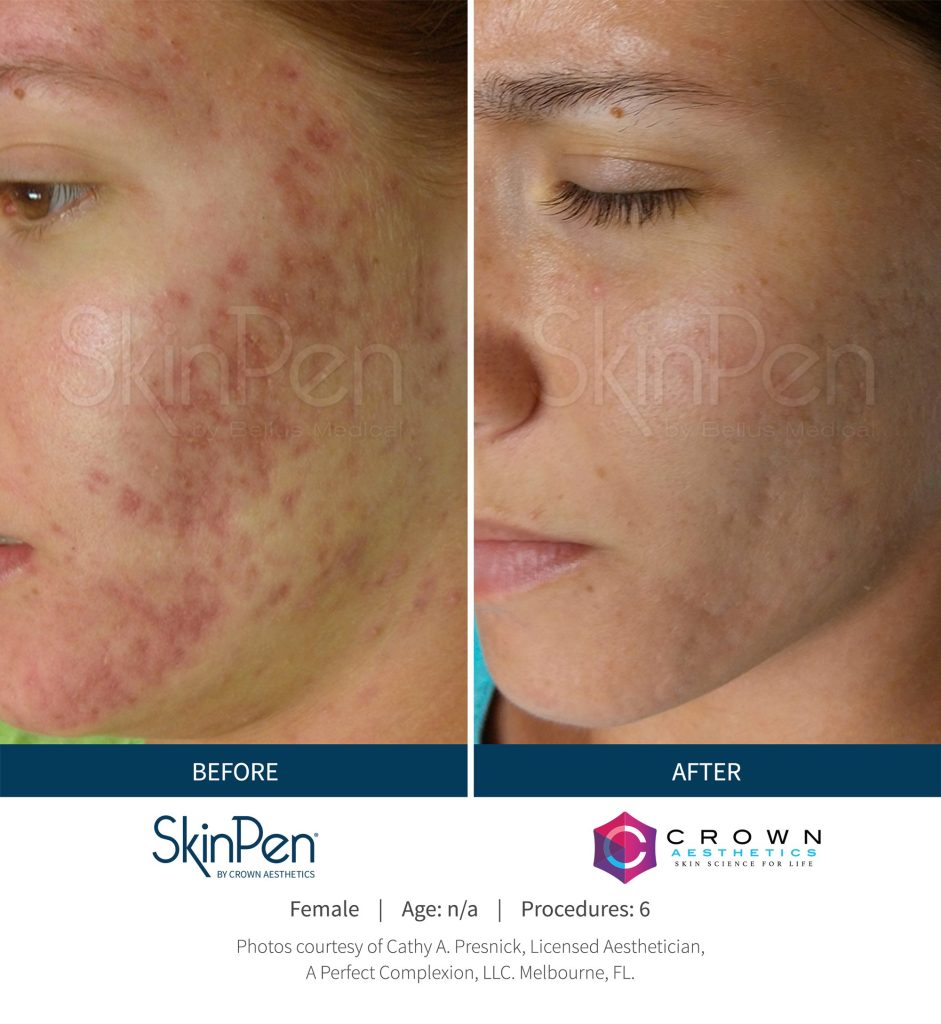 SkinPen treatment example 2